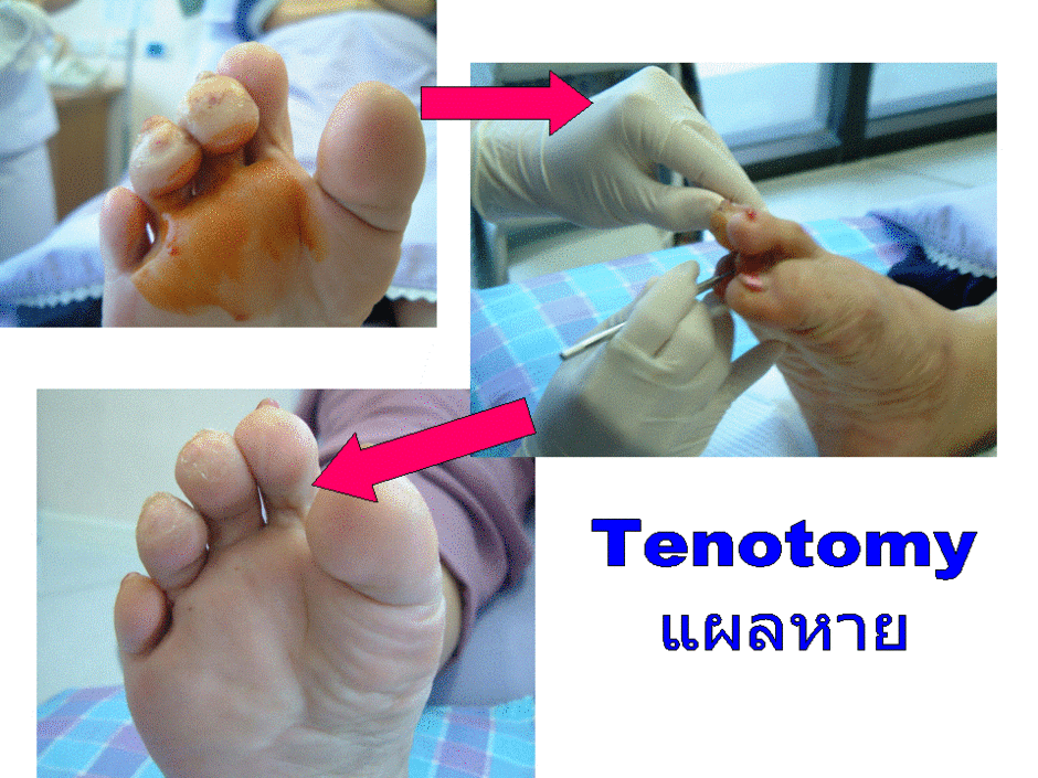 tenotomy