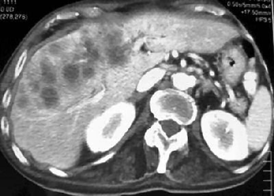 cancer image