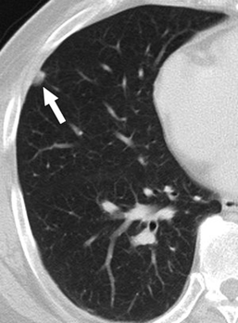 ct lung