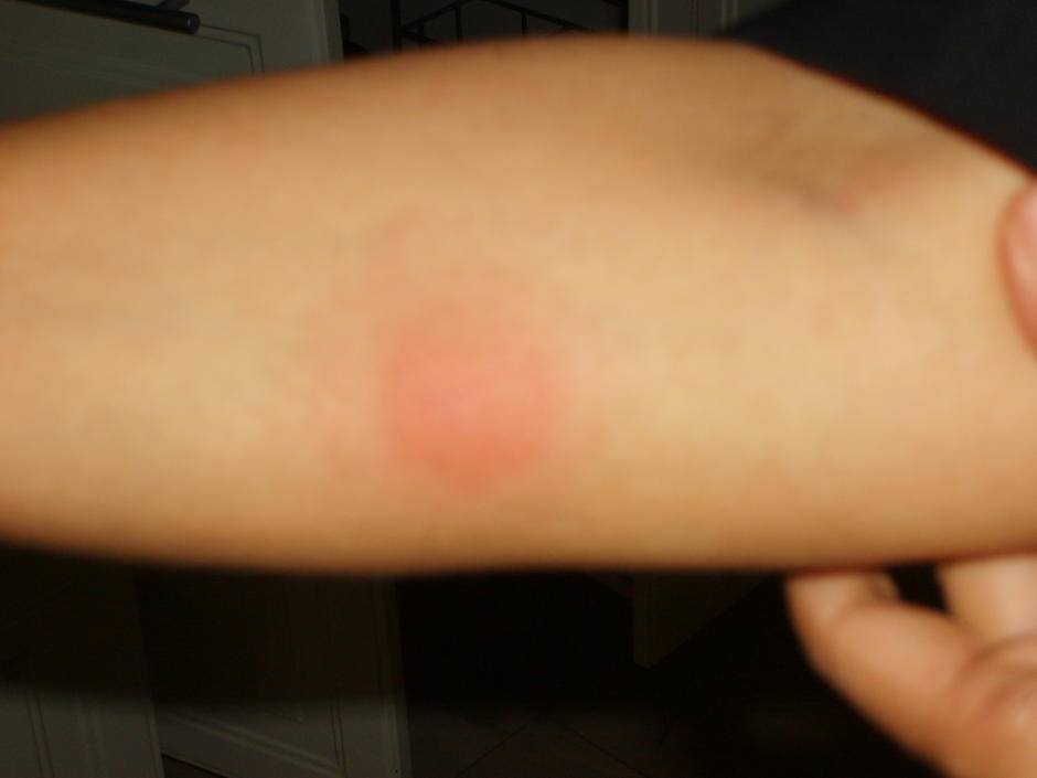 tuberculin test
