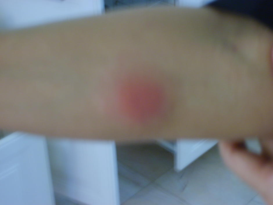 tuberculin test