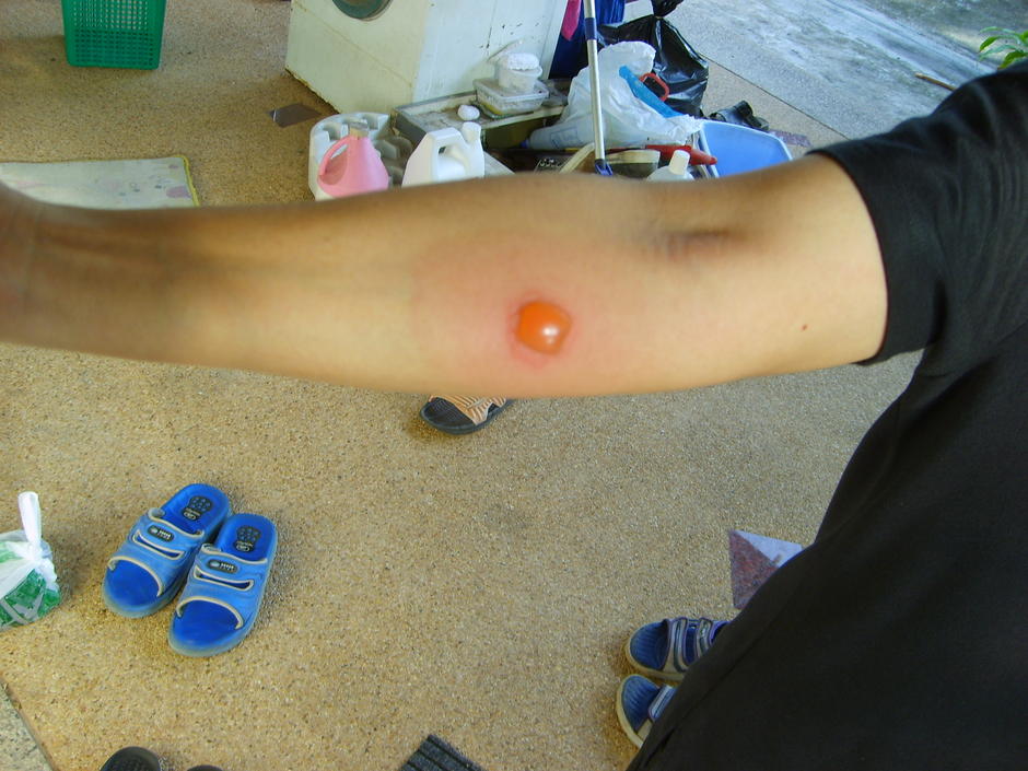 tuberculin test
