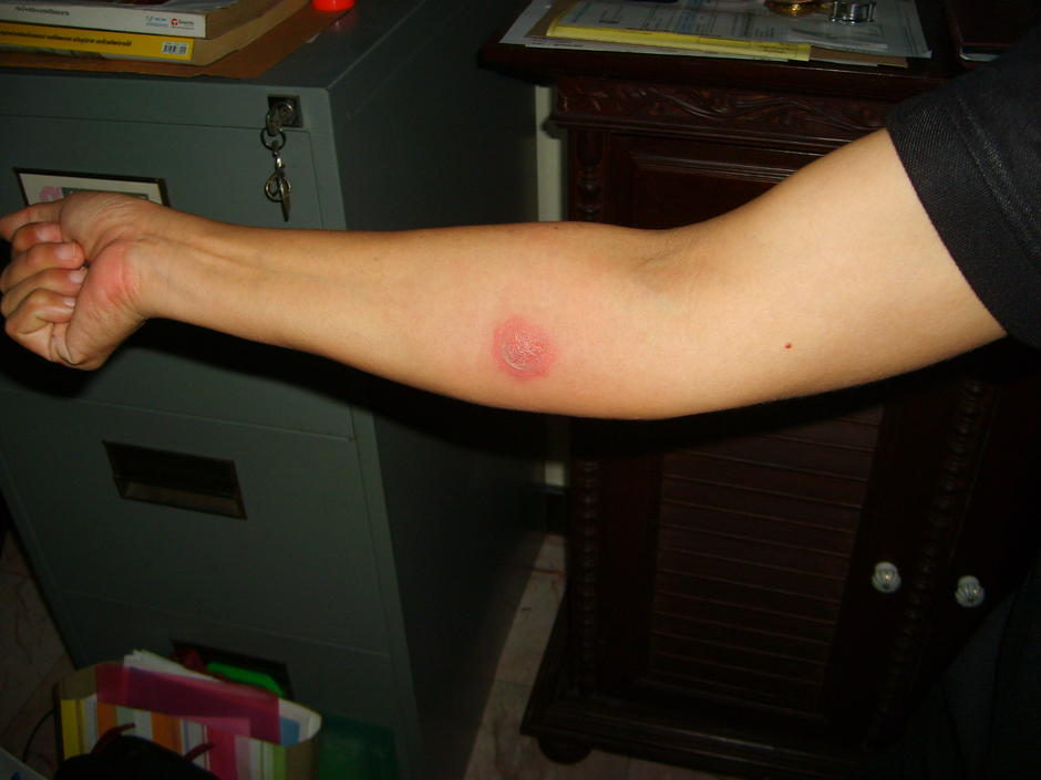 tuberculin test