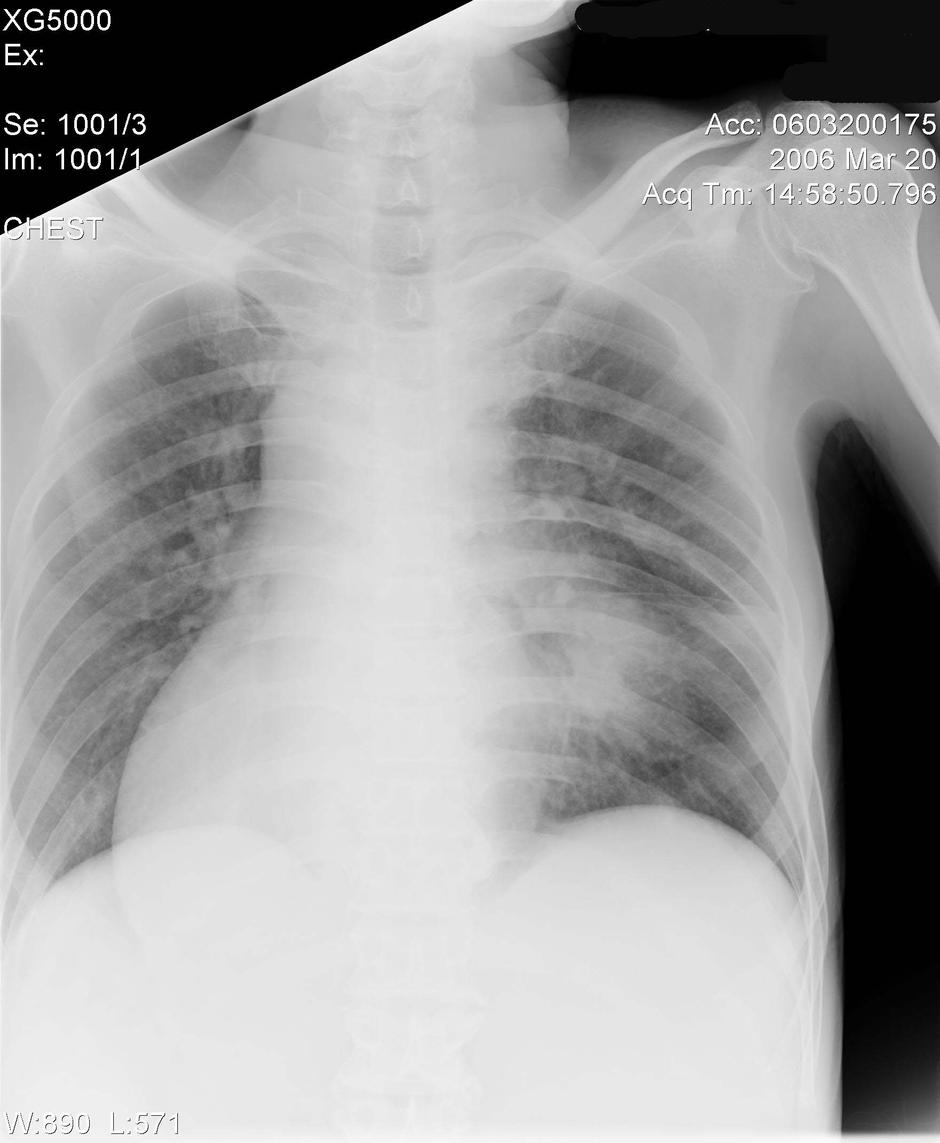 chest