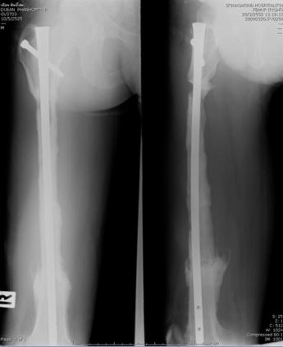femur