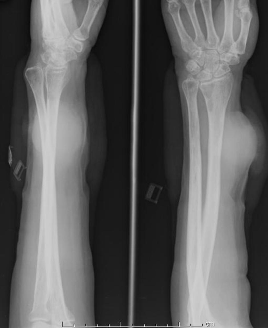 forearm