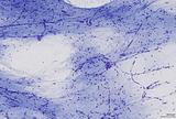 Small_nh11-1164ganglioglioma