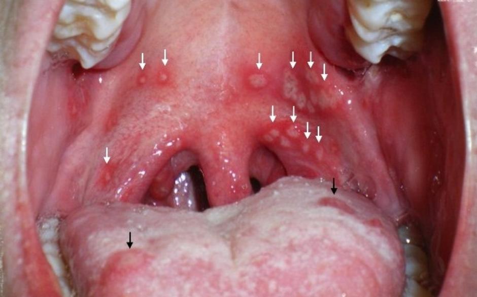 Oral thrush - Mayo Clinic