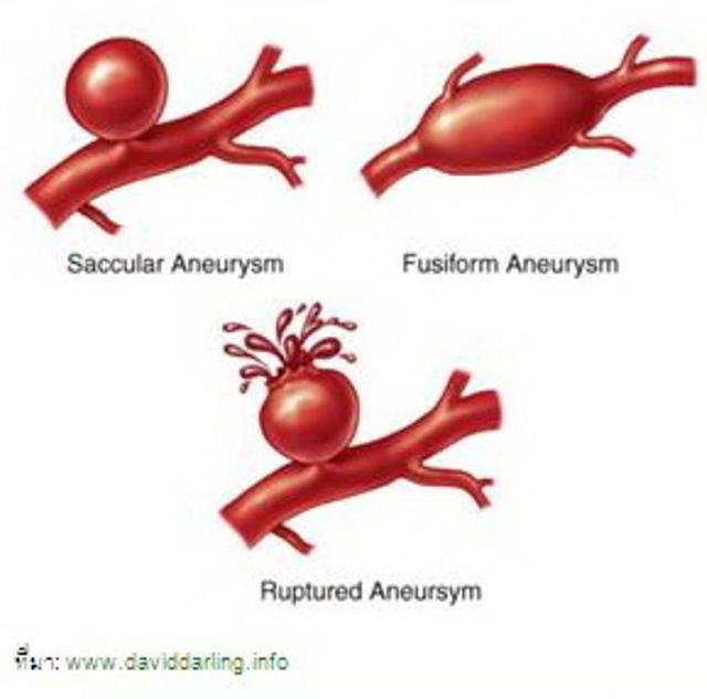 aneurysm : story telling - GotoKnow